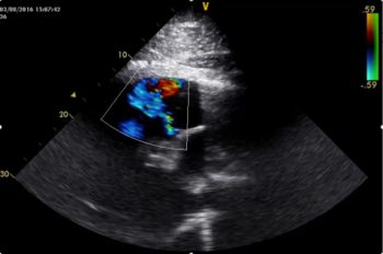 Figure 3. This is an echocardiogram obtained in a 20-year-old polocrosse pony where a grade IV/VI pandiastolic blowing decrescendo murmur point of maximal intensity left intercostal 4 was found on a routine evaluation. This is a left-sided cranial view of the pulmonary artery and right ventricular outflow tract obtained through the triceps left intercostal 3, demonstrating moderate pulmonary regurgitation. This horse is still in ridden work and will be monitored annually.