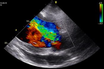Figure 4. This is an echocardiogram obtained in an 18-year-old Arabian gelding used for endurance where a grade IV/VI pandiastolic decrescendo murmur point of maximal intensity left intercostal 4 was found at a competition. This is a left-sided parasternal cranial view of the aorta and left ventricular outflow tract demonstrating severe aortic regurgitation. This horse has been monitored across six years and his left ventricle has gradually increased in size, but exercising ECG has never demonstrated any abnormalities, so he has continued to be ridden. 