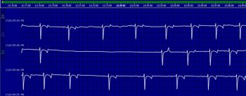 Figure 5. This is a resting ECG from a 12-year-old Thoroughbred mare used for general-purpose riding. An irregular rhythm found prior to sedation prompted this evaluation. When this mare was relaxed, she had sinoatrial arrest (as demonstrated here). This rhythm abnormality disappeared at exercise, so was regarded as physiological (although is not always so). 