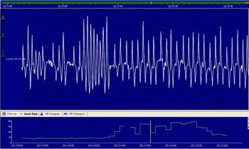 Figure 6. This is an exercising ECG obtained from a 12-year-old Irish sport horse mare used for hunting. She presented with epistaxis after pulling up during exercise and auscultation, and resting ECG confirmed atrial fibrillation. This horse had a high heart rate for the degree of exercise undertaken and a fast idioventricular response. We were concerned this rhythm could develop into ventricular fibrillation. She underwent successful electrocardioversion and, 18 months later, she is still in sinus rhythm. 