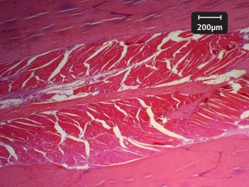 Figure 2a. Histological section (haematoxylin and eosin) of a suspensory ligament, with normal collagen, adipose tissue and muscle architecture. In the abnormal ligament, a considerable part of the central muscle tissue is replaced by fat and fibrosis. There is internalisation of muscle cell nuclei.