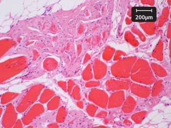 Figure 2b. Histological section (haematoxylin and eosin) of a suspensory ligament with ultrasonographic evidence of proximal suspensory desmopathy (right). In the abnormal ligament, a considerable part of the central muscle tissue is replaced by fat and fibrosis. There is internalisation of muscle cell nuclei.
