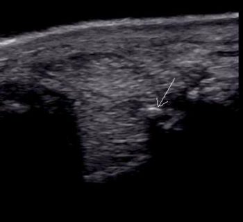 Figure 3a. Transverse ultrasonographic image of a suspensory ligament branch. Dystrophic mineralisation is in the axial aspect of the ligament, with an adjacent focal anechogenic area in the transverse image. This dystrophic mineralisation results in acoustic shadowing, particularly evident in the longitudinal image.