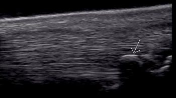 Longitudinal (proximal to the left) ultrasonographic images of a suspensory ligament branch. Dystrophic mineralisation is in the axial aspect of the ligament, with an adjacent focal anechogenic area in the transverse image. This dystrophic mineralisation results in acoustic shadowing, particularly evident in the longitudinal image.