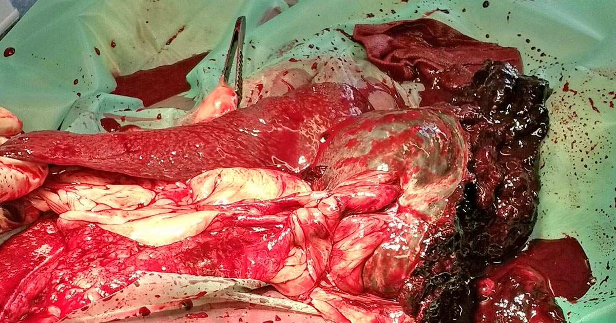 Splenic rupture