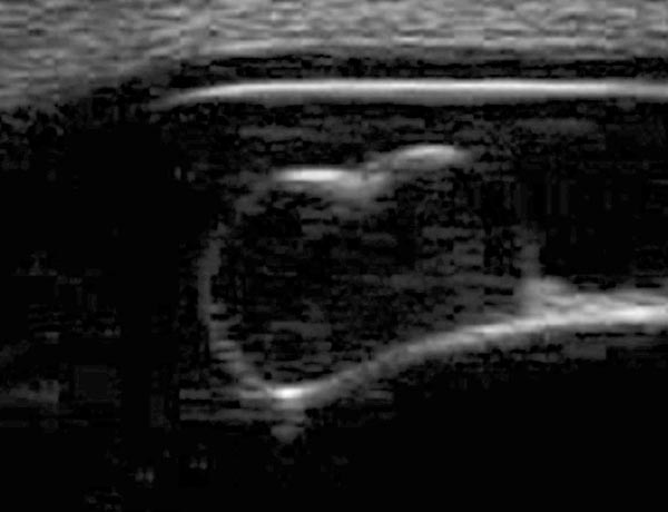 Figure 4b. Ultrasonographic images showing the masses to be fluid-filled cysts.