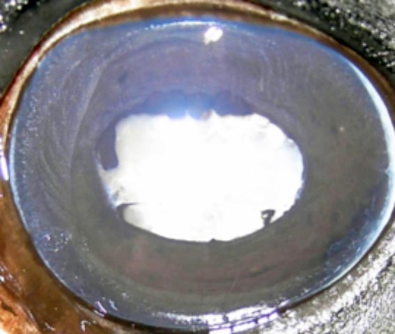Figure 5a. A dense cataract involving entire lens capsule and nucleus.