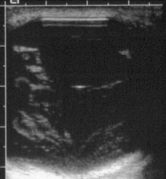Figure 6. Extensive vitreal debris.