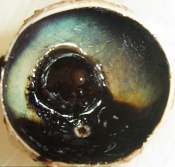 Figure 8b. Retinal melanoma.