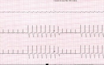 Figure 1. Ventricular premature complexes.