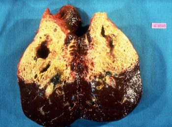 Figure 2. Alveolar Echinococcus multilocularis cysts in liver. IMAGE: Bayer.