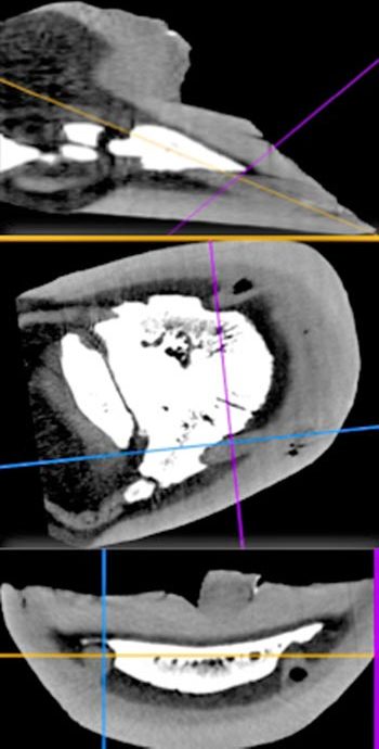 Figure 12. Advanced imaging is invaluable in ensuring the excision of all masses.