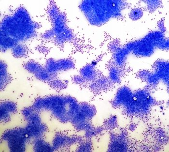 10× image from a rapidly growing mass in the anal sac of an adult male English cocker spaniel.