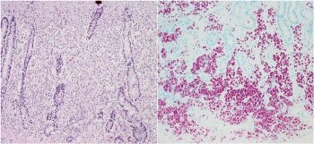 The thickened small intestine from a sheep. Left: crypts separated by sheets of macrophages in the lamina propria (haemotoxylin and eosin). Right: macrophages contain vast numbers of intracellular acid-fast (Ziehl-Neelsen, bright pink) bacilli consistent with Mycobacterium avium paratuberculosis (Johne’s disease).