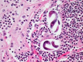 A lung from an adult goat with pneumonia: two coiled nematode larvae (Muellerius capillaris) are surrounded by degenerate neutrophils and macrophages.