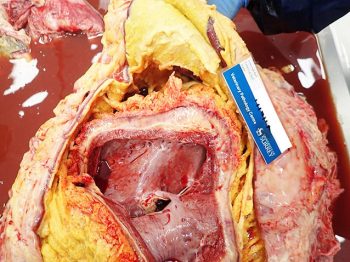 Severe fibrinosuppurative (“bread and butter”) pericarditis in a cow with traumatic reticulopericarditis following ingestion of a piece of wire from a tyre.