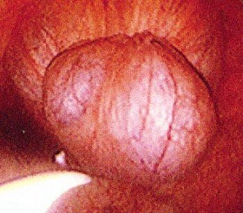 Figure 3. A uterine cyst with a biopsy snare for treatment using electrocoagulation. Adapted from Stanton, 200410.