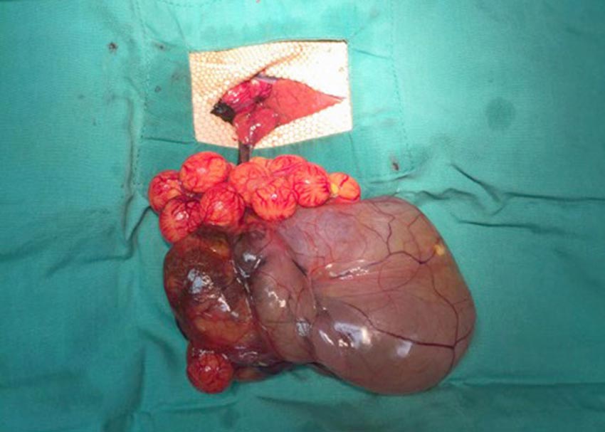 A view of the ovarian teratoma. Figure 2. Before ligation of the ovarian stump. 