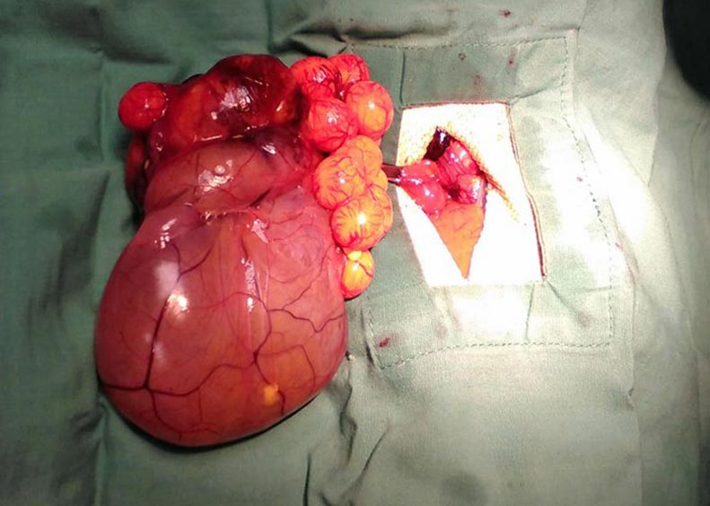 A view of the ovarian teratoma. Figure 3. The ovarian stump, the tumour and normal-looking follicles attached to the tumour.