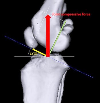 Figure 2. Representation of the tibiofemoral forces according to Slocum and Devine (1993). Axial compression of the pelvic limb results in a compressive force across the stifle (red arrow), which can be broken down into its two orthogonal components: one perpendicular (green arrow) and one parallel (yellow arrow) to the tibial plateau (represented by a dashed blue line). The latter force represents the tibiofemoral shear force or tibial thrust. Because of the caudally directed tibial slope, compression results in tibial cranial translation normally passively counteracted by the canine cranial cruciate ligament in an intact stifle.