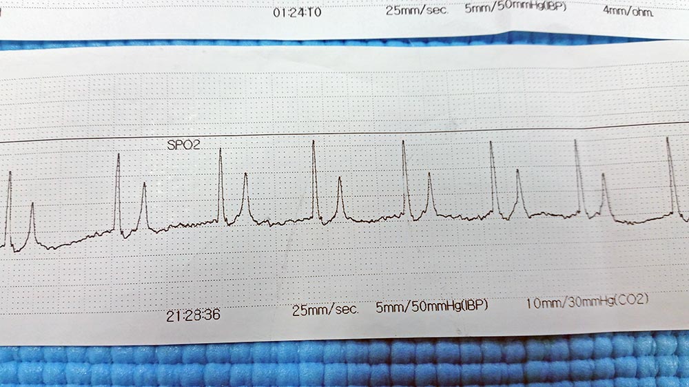 An example of absent P waves and peaked T waves.