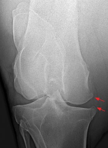 Figure 4d. A caudocranial radiograph of a right stifle, with marked periarticular osteophyte formation. The red arrows in all the images demonstrate pathology.