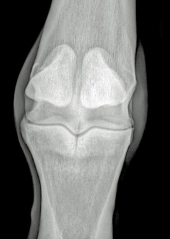 Figure 3. A short incomplete proximal phalanx fracture.