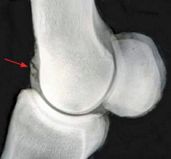 Figure 4b. A lateromedial radiograph of the right fore fetlock of a skeletally mature horse, demonstrating fragmentation of the sagittal ridge of the third metacarpal bone.