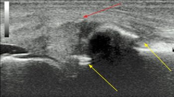 Figure 5. An ultrasonographic image of a left medial femorotibial joint. Proximal is to the left. A fracture of the proximo-medial aspect of the tibia is present (yellow arrows) and protrusion of the medial meniscus beyond its normal location within the boundaries of the proximal tibia and distal femur (red arrow).