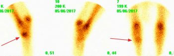 Figure 6a. Nuclear scintigraphic images showing increased radiopharmaceutical uptake (IRU) in the left distal tarsus. The red arrows demonstrate IRU.