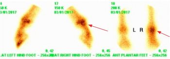 Figure 6b. Nuclear scintigraphic images showing increased radiopharmaceutical uptake (IRU) in the right hind fetlock. The red arrows demonstrate IRU.