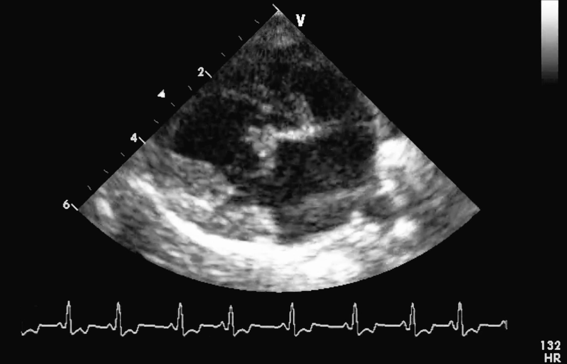 Figure 1. Right parasternal long-axis, four-chamber view of the heart of a 12-year-old male neutered Chihuahua with grade four to grade five, left apical, systolic murmur classified with stage B2 degenerative mitral valve disease. The septal mitral valve cusp is irregular, thickened and prolapsing. The left ventricle appears dilated. Normalised (for body surface area) left ventricular internal diameter during diastole was 1.8 (reference less than 1.7), consistent with eccentric hypertrophy. The left atrium appears enlarged.