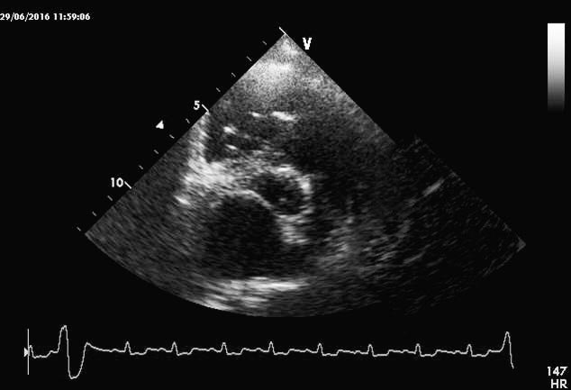 Figure 2. Right parasternal short-axis view of the heart base of the same Chihuahua, demonstrating an enlarged left atrium. This is ascertained by the ratio of the left atrium to aortic diameter (2.1, reference less than 1.6).
