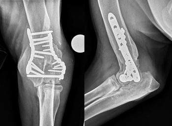 Figure 2. Craniocaudal (left) and mediolateral (right) views of the left elbow of a 10-month-old St Bernard that suffered an intercondylar Y fracture aged 4 months, which was stabilised using medial and lateral plates, and a transcondylar screw. Note the multiple small, slightly irregularly marginated lucencies along the lateral subchondral bone of the left humerus and thickening of the soft tissues surrounding the distal humerus, with various-sized regions of mineralisation. This appearance is consistent with progressive post-traumatic OA.