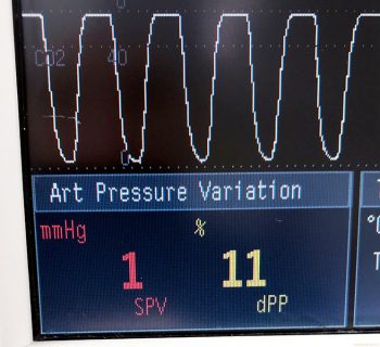 Figure 4a. Pulse pressure variation before receiving a