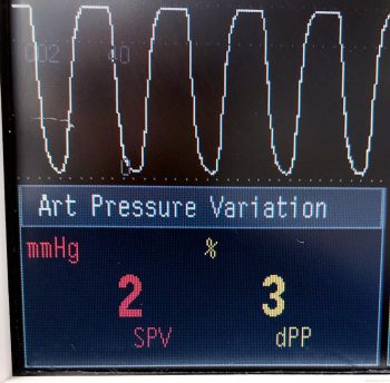 Figure 4b. Pulse pressure variation after receiving 10ml/kg crystalloid fluid bolus.