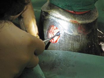 Figure 6b. Debridement of the laminar tissue via a partial hoof wall resection.