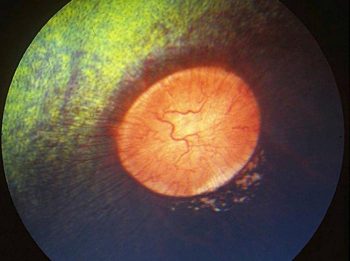 Figure 2. A case of multifocal chorioretinopathy, which can be associated with equine recurrent uveitis.