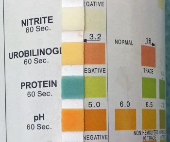 Proteinuria is relatively common with both CKD and hyperthyroidism. Proteinuria associated with hyperthyroidism tends to resolve following successful treatment of this condition.