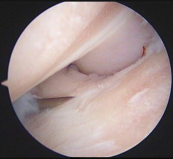 Figure 2b. Image taken of the same dog’s elbow using arthroscopy, showing the cartilage has been completely eroded.