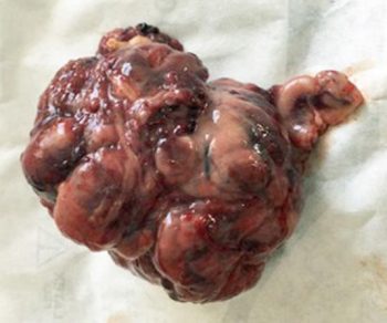 Figure 4. The abnormal right ovary attached to the rest of the reproductive tract. 