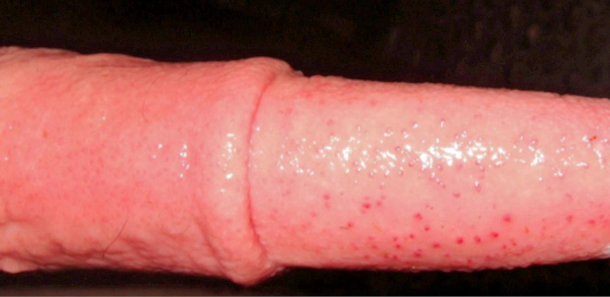 Figure 4. Infectious pustular balanoposthitis in a bull – multifocal pustules/papules on the penis.