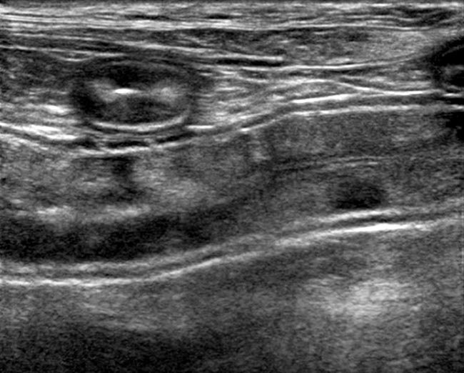 Figure 1. An ultrasonographic image showing hyperechogenicity and patchy changes of the mucosal surface in the small intestine of a dog with IBD and suspected lymphangiectasia.