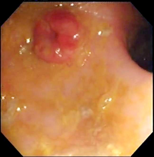 Figure 5. An endoscopic view of the colon, ileal papilla and caecocolic junction (right).