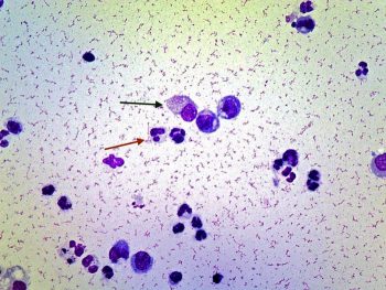 <strong>Figure 2.</strong> A high magnification photomicrograph of the abdominal fluid.