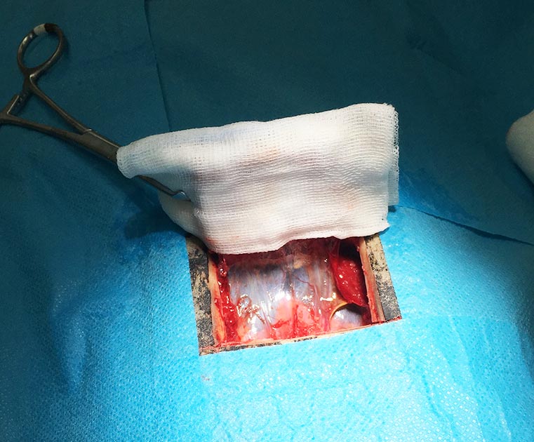 Figure 2. The reflected window of bone preserving the cranial soft tissues.