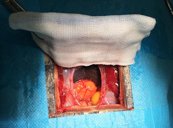 Figure 3b. The incision between the abdominal blood vessels to enter the coelomic cavity.