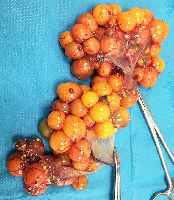 Figure 5. All ovarian tissue removed.