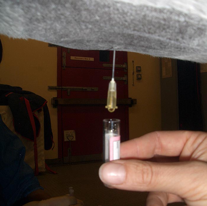 Figure 7. Collection of a peritoneal fluid sample using a 2in, 19-gauge needle.
