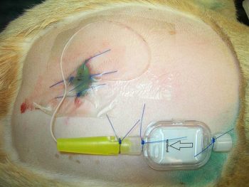 Figure 4. An epidural catheter.